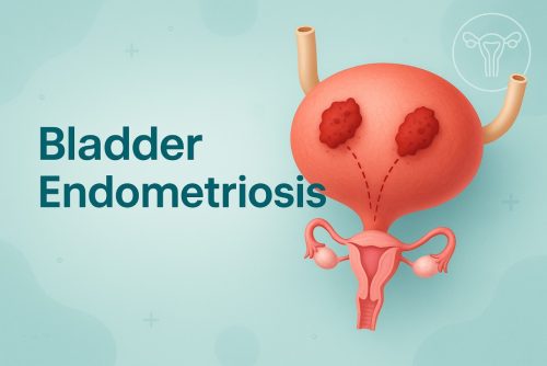 Bladder Endometriosis