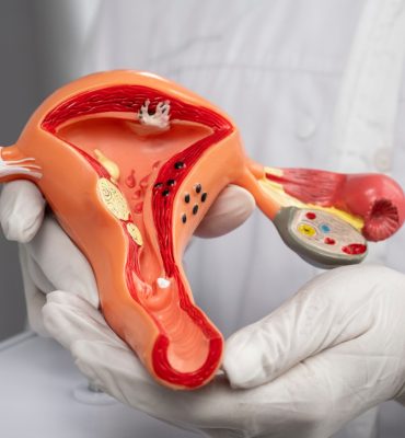 Scar Endometriosis (1) (1)