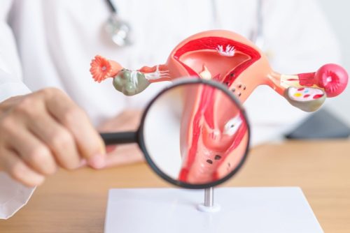 Uteral Endometriosis (1)