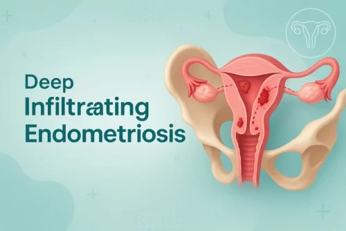 Deep Infiltrating Endometriosis