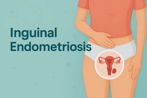 Inguinal Endometriosis