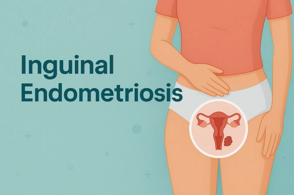Inguinal Endometriosis