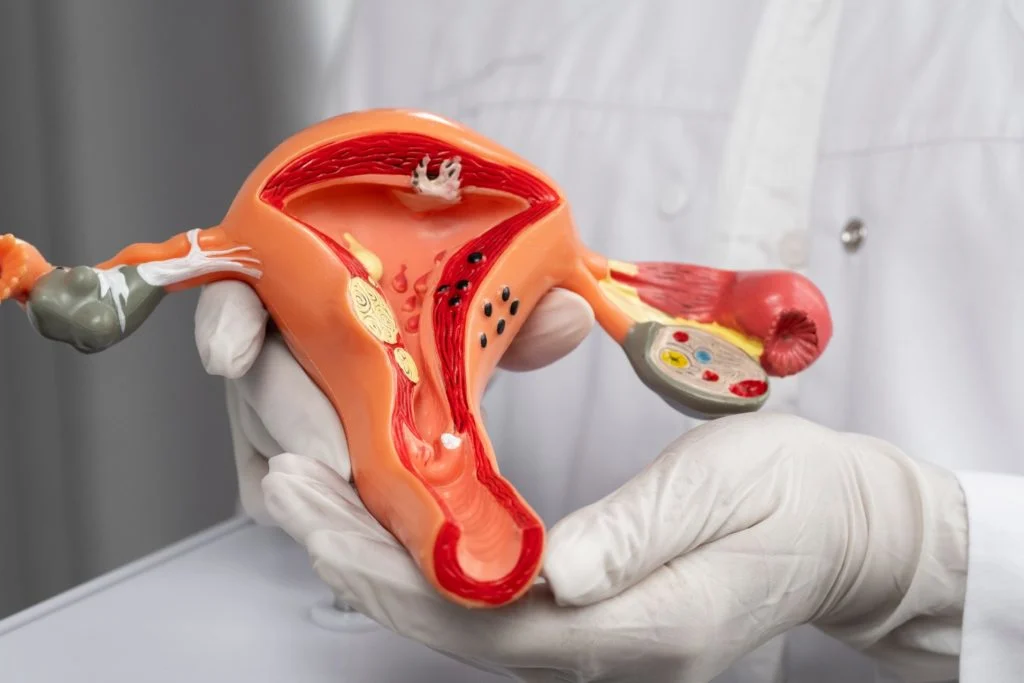 Scar Endometriosis