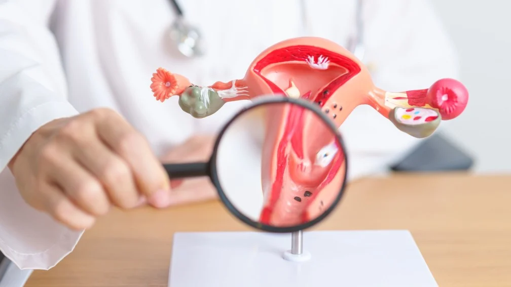 Ureteral Endometriosis