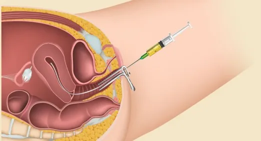 Endometriosis and Fertility Treatment