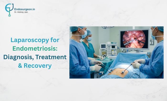Laparoscopy for Endometriosis