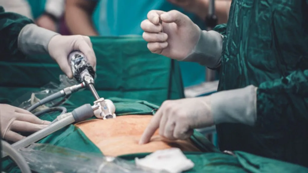 Laparoscopy for Endometriosis
