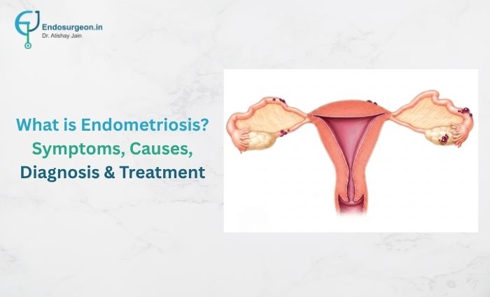 What is Endometriosis