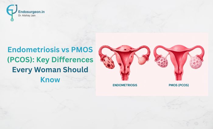 Endometriosis vs PMOS