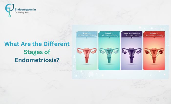 Stages of Endometriosis
