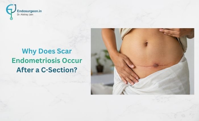 Scar Endometriosis Occur After a C-Section